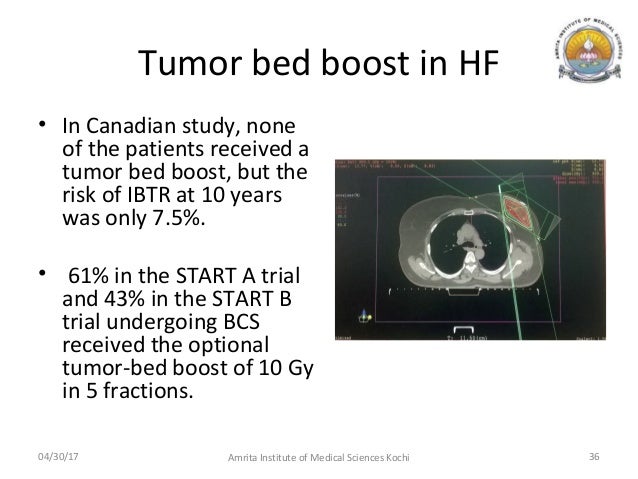 radiation electrons breast cancer Radiation electrons breast cancer